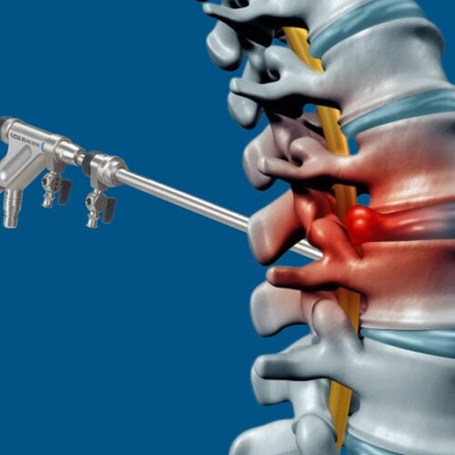 Endoscopic Lumbar Surgery
