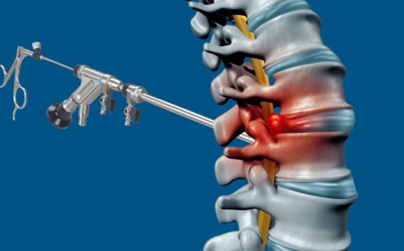 Endoscopic Lumbar Surgery