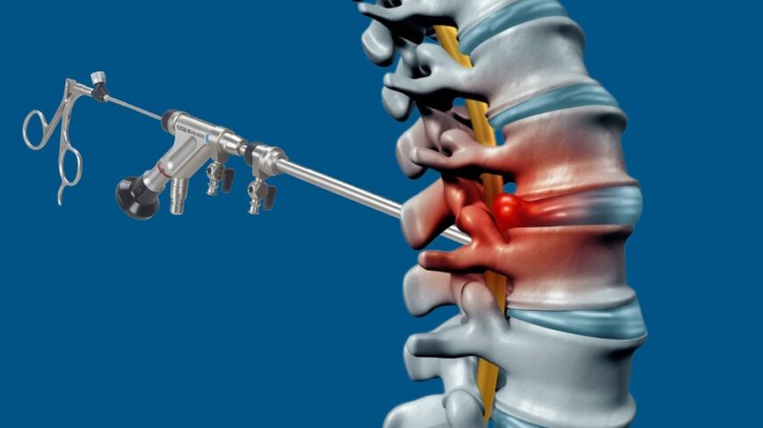 Endoscopic Lumbar Surgery