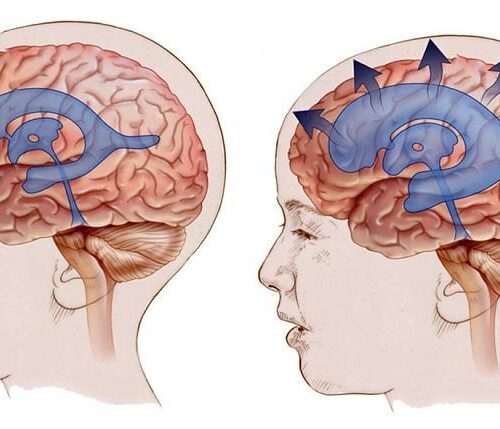 Pseudotumor Cerebri (Idiopathic Intracranial Hypertension)