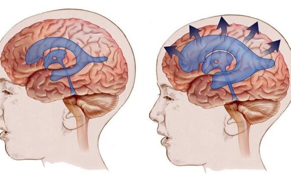Pseudotumor Cerebri (Idiopathic Intracranial Hypertension)