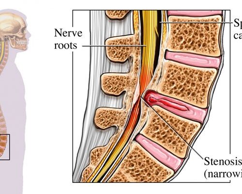 Spinal Canal Stenosis