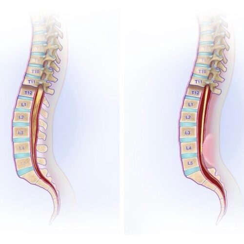 What Is Tethered Cord Syndrome?