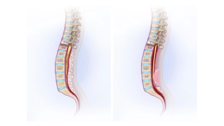 What Is Tethered Cord Syndrome?