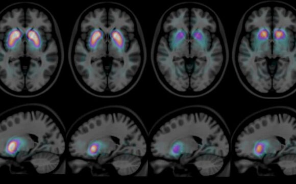 Frequently Asked Questions About Dementia